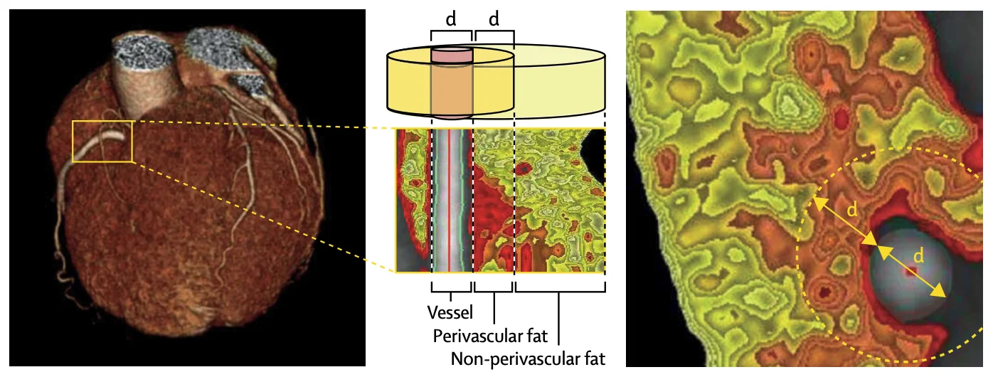 CRISP-CT figure - The Lancet 2018
